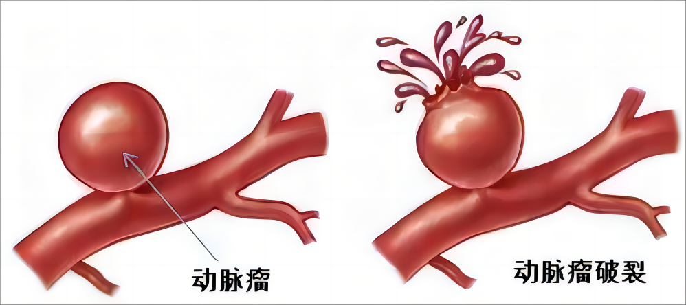 脑子里的“炸弹”|颅内动脉瘤(图4)