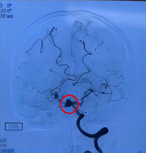脑子里的“炸弹”|颅内动脉瘤(图7)