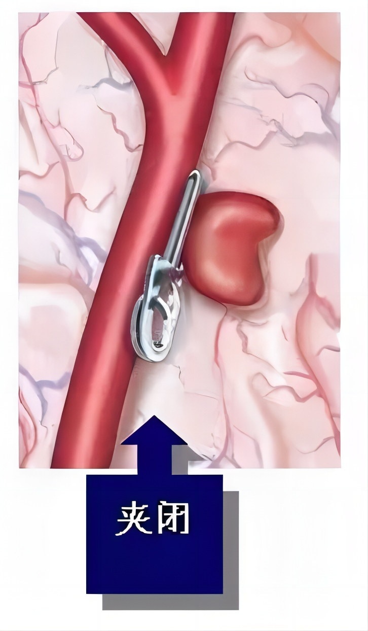 脑子里的“炸弹”|颅内动脉瘤(图8)