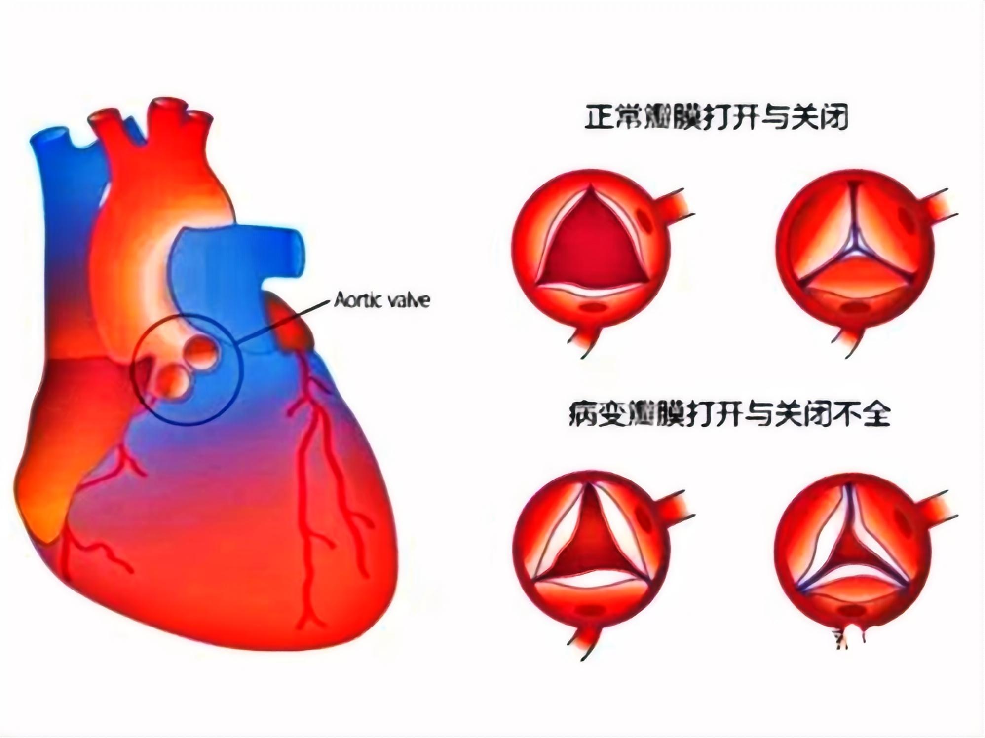 关注心衰，守护心脏(图4)