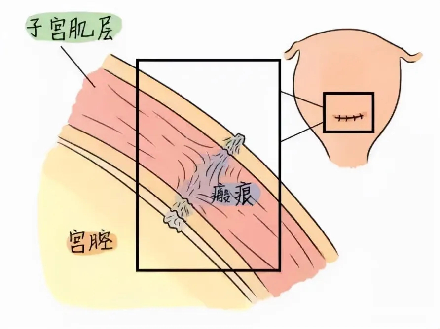 一场生命与风险的较量 | 瘢痕妊娠(图1)