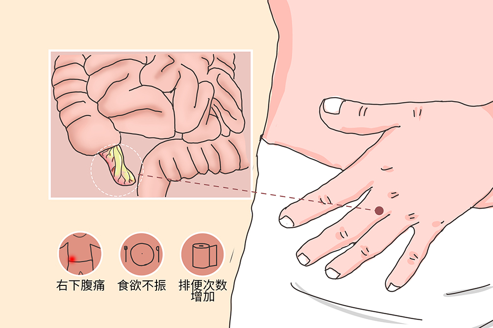 阑尾炎你还在一切了之吗？ERAT——不开刀治疗阑尾炎的新方法(图4)