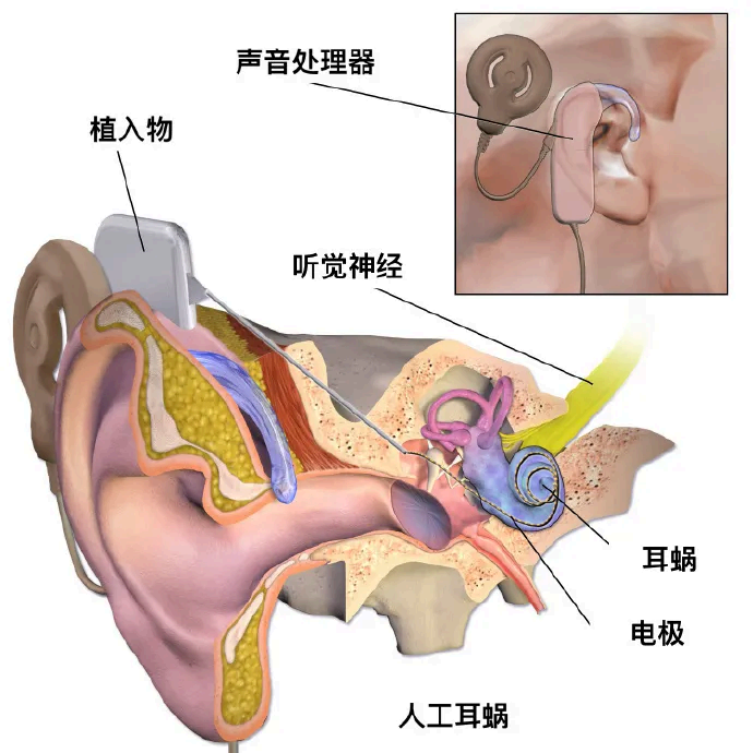 重塑听觉的“黑科技”-人工耳蜗植入术(图1) 1-260Q2195301194.png